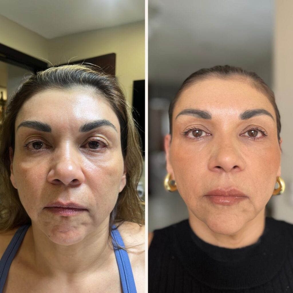 Armonización facial en clínica estética con técnica full face para mejorar volumen y simetría facial"