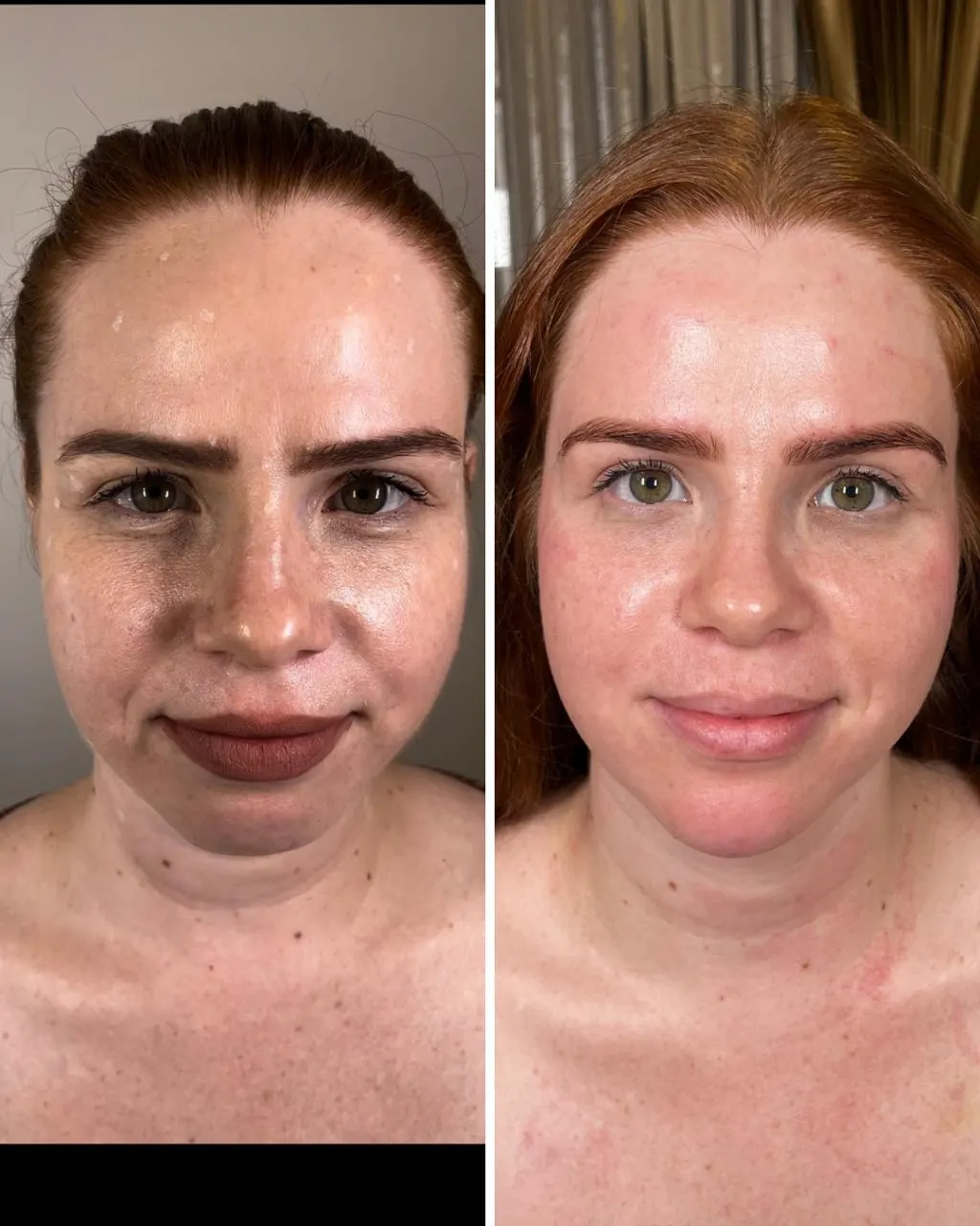 Armonización facial