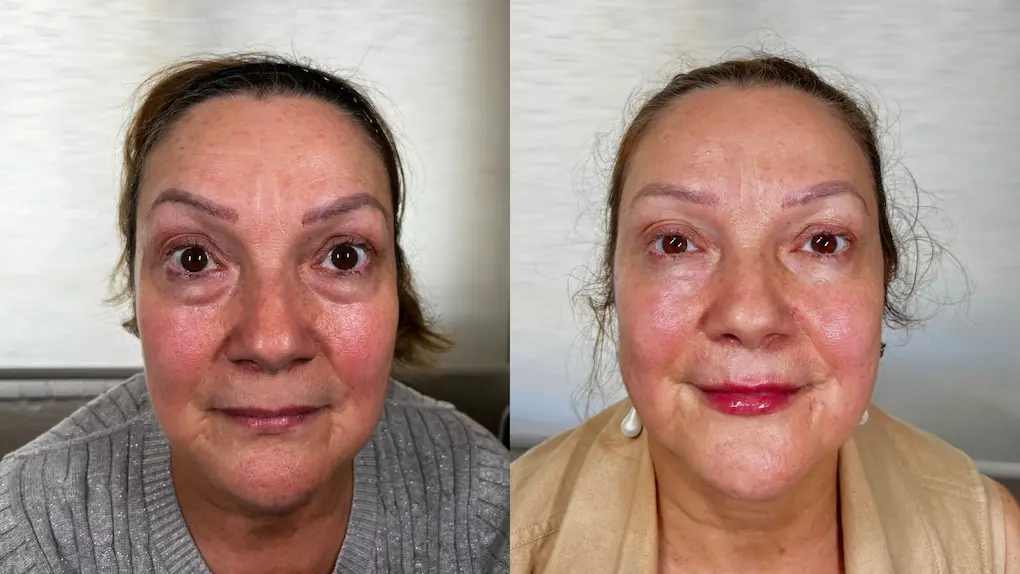 Armonización-facial