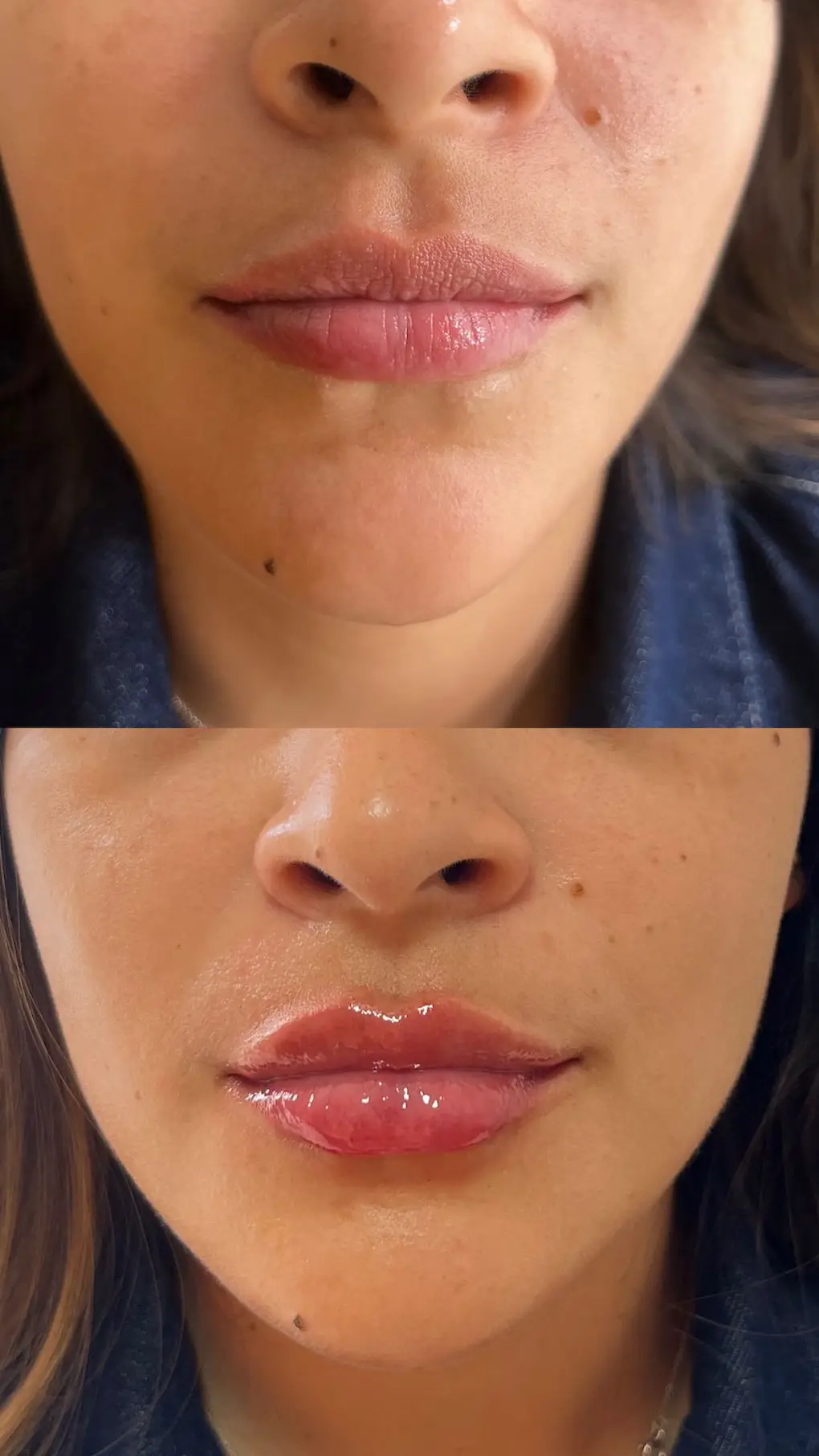Aumento-de-labios