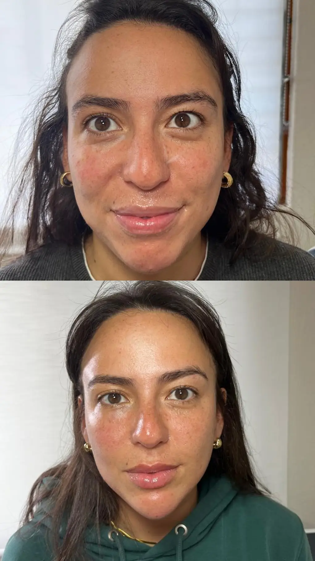 Correcion-de-labios-con