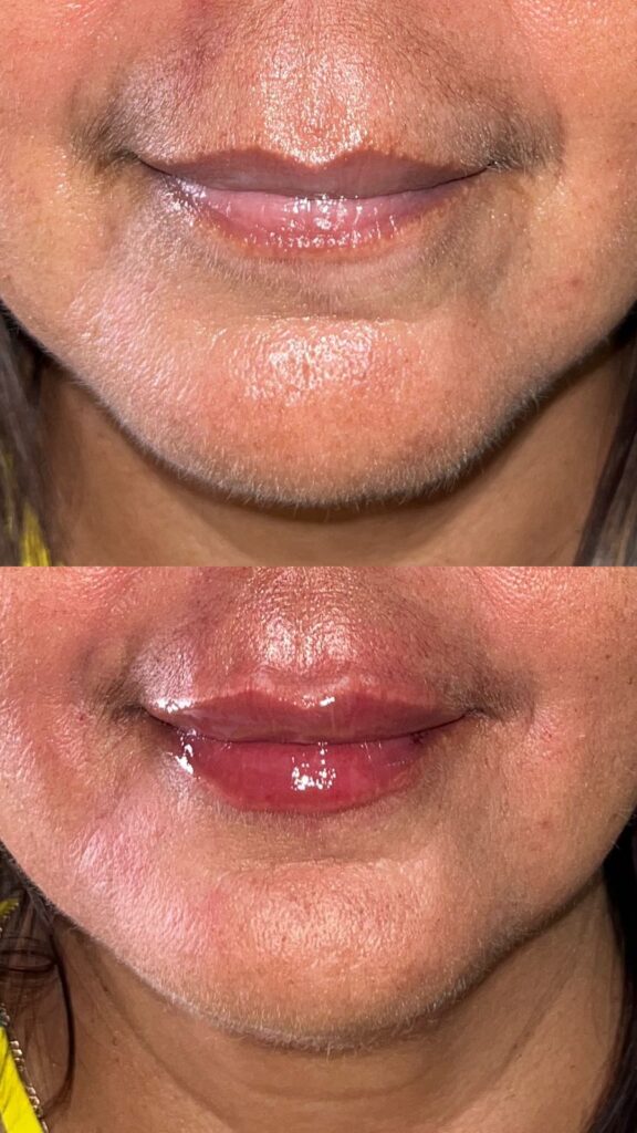 antes y después del relleno de labios