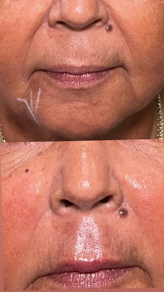 Antes y después del relleno de surcos nasogenianos