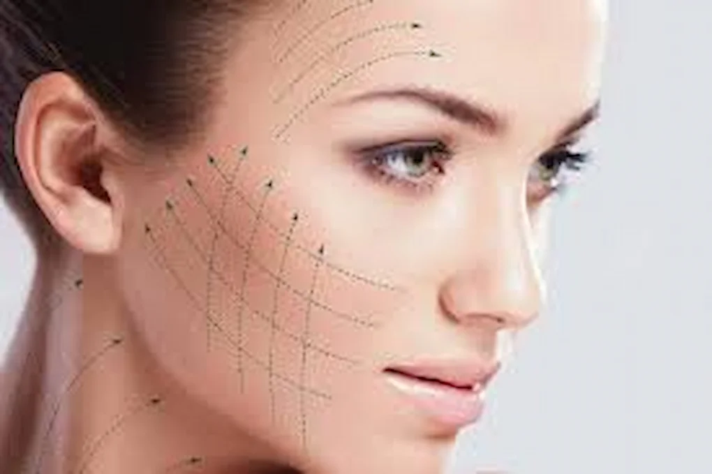 Resultados antes y después de hilos tensores en mejillas y contorno facial