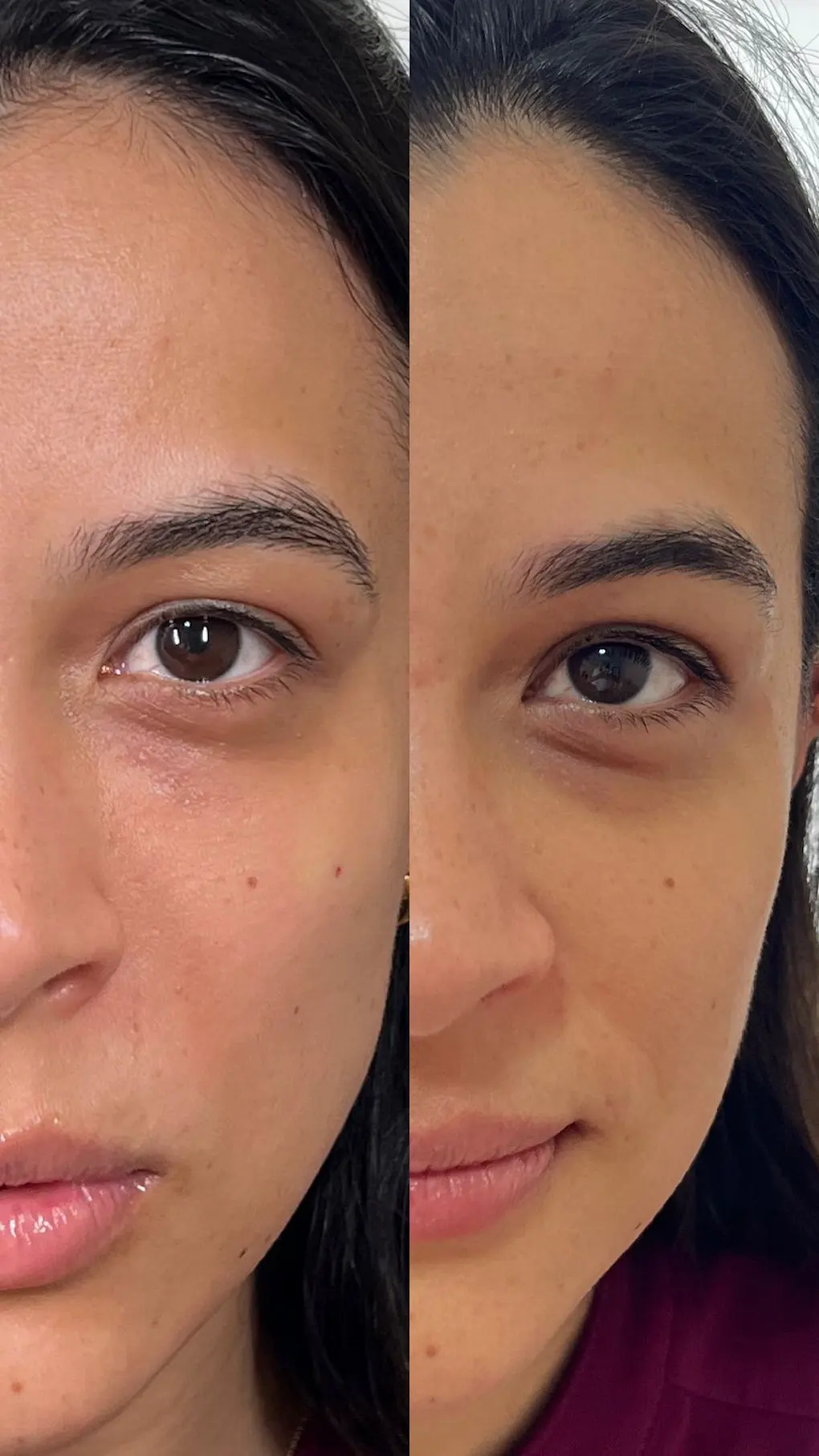 correcion-de-ojeras-