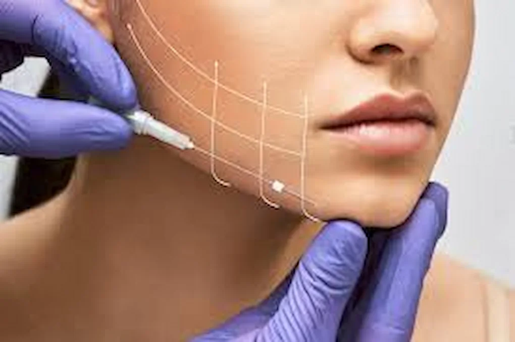 Hilos tensores para rejuvenecer el rostro y mejorar la flacidez facial sin cirugía