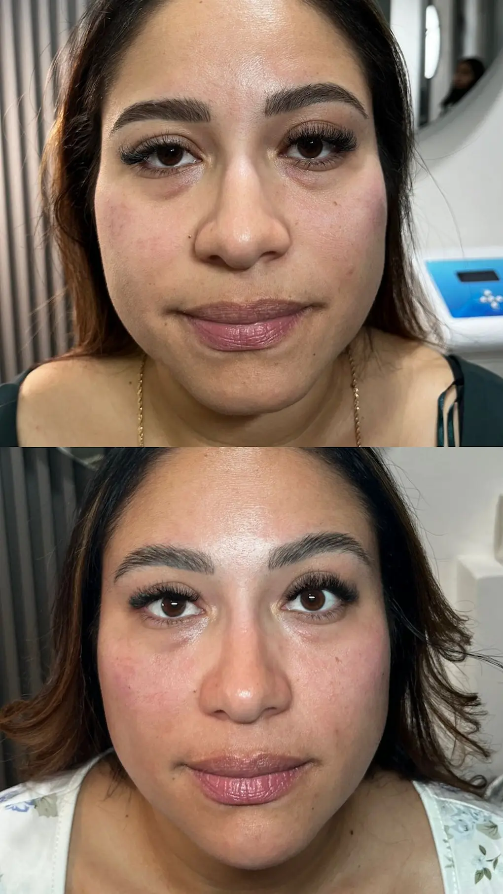 relleno-de-ojeras